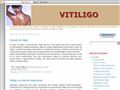 Vitiligo